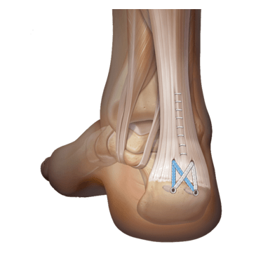 AO法 骨折治療 Foot and Ankle AO法骨折治療 Foot and Ankle [英語版Web付録付] (AOTRAUMA
